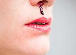 Cure For Nose Bleeding